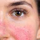What Is Rosacea And How To Treat It